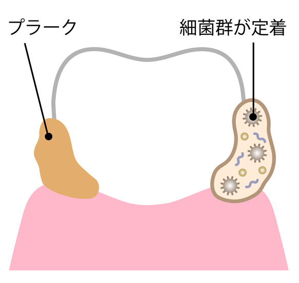 歯の表面に付着した薄茶色の「プラーク」と、その内部に多数の歯周病菌などの「細菌群が定着」している様子を左右で比較・解説した図解イラスト。