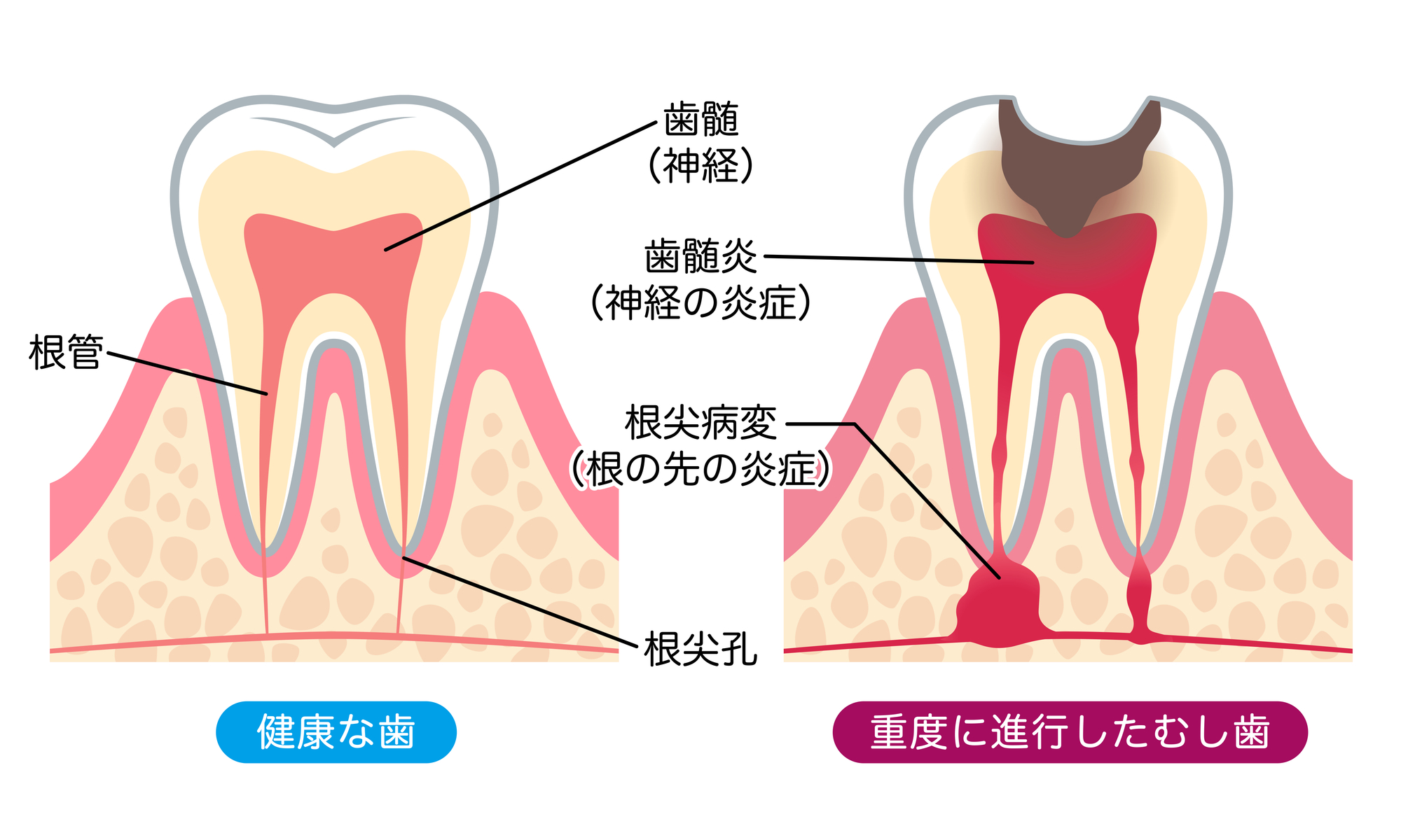 「健康な歯」と「重度に進行したむし歯」の断面を比較した構造イラスト。むし歯の進行によって歯髄炎(神経の炎症)が起き、根尖病変(根の先の炎症)へと至る経過が、「歯髄」「根管」「根尖孔」などの注釈付きで示されている。