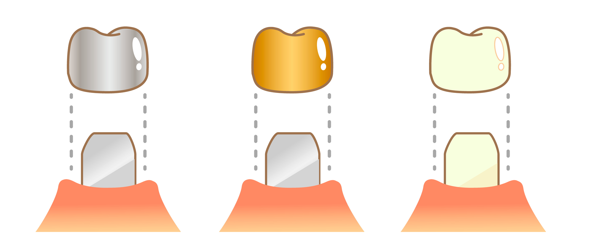 土台(コア)を整えた歯に全体を覆う被せ物(クラウン)を装着する構造イラスト。銀(金属)、金(ゴールド)、白(セラミック・レジン等)の3種類の素材例が並んで示されている。