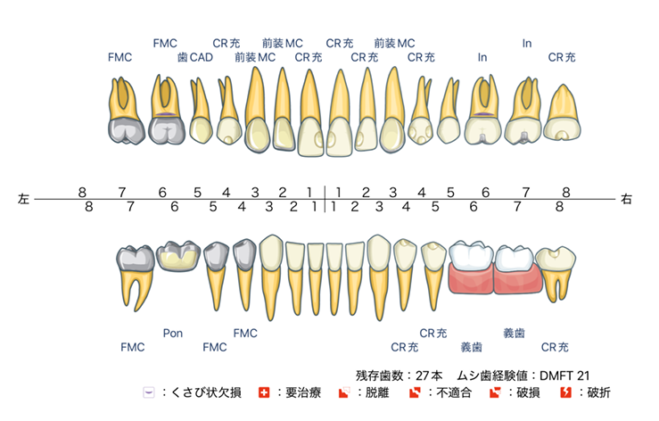 全歯のイラストにむし歯や被せ物・詰め物の状況(FMC、CR充、義歯など)が記され、残存歯数や治療が必要な部位をまとめた「お口の診断書」のサンプル画像。